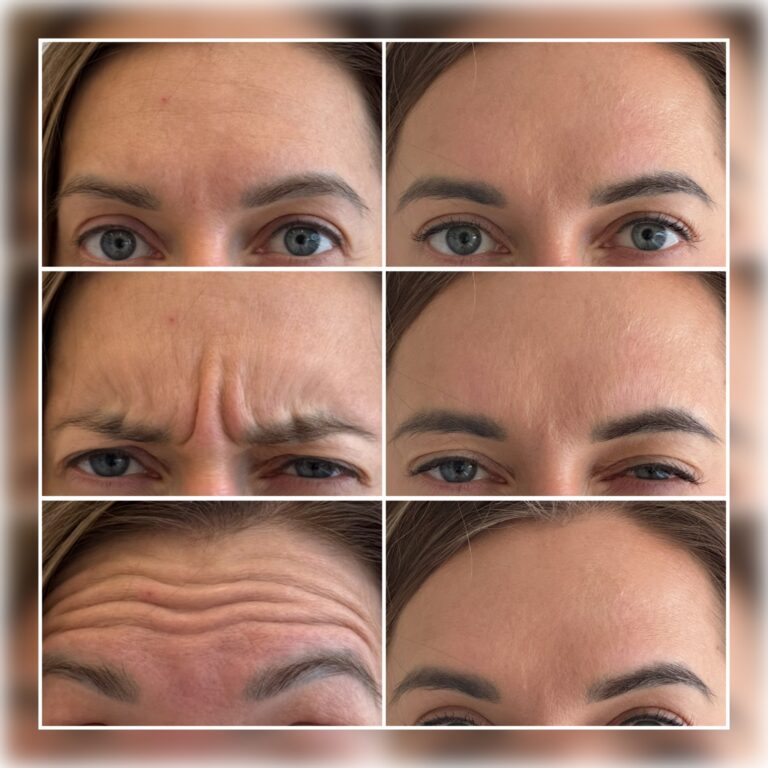 Botulismi toksiini tulemus Karin Rallmanni käe all