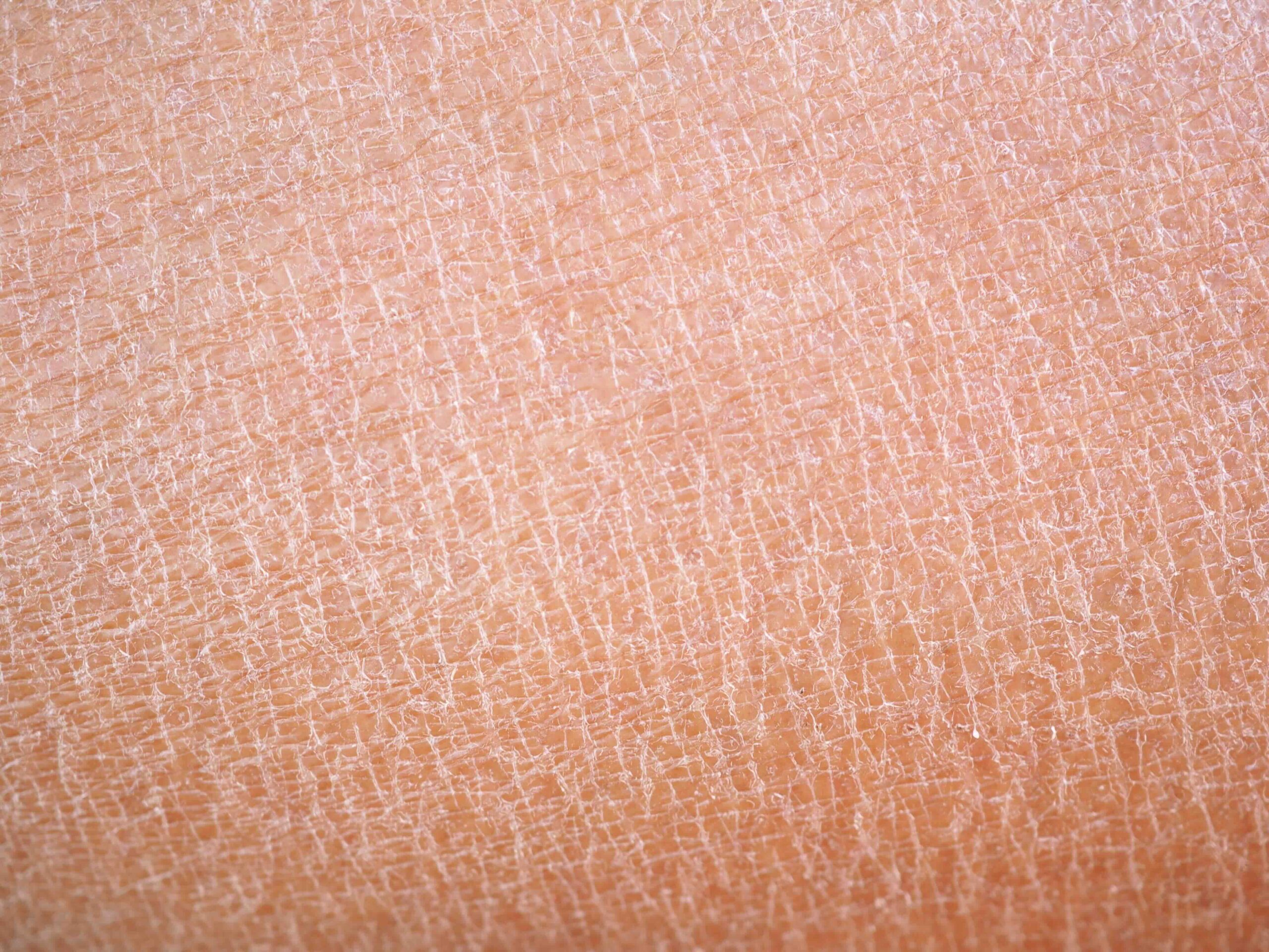 Kuiv nahk: miks see tekib ja kuidas seda toetada?