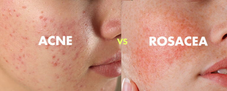 Akne vs rosaatsea