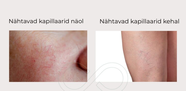 Näited nähtavatest kapillaridest