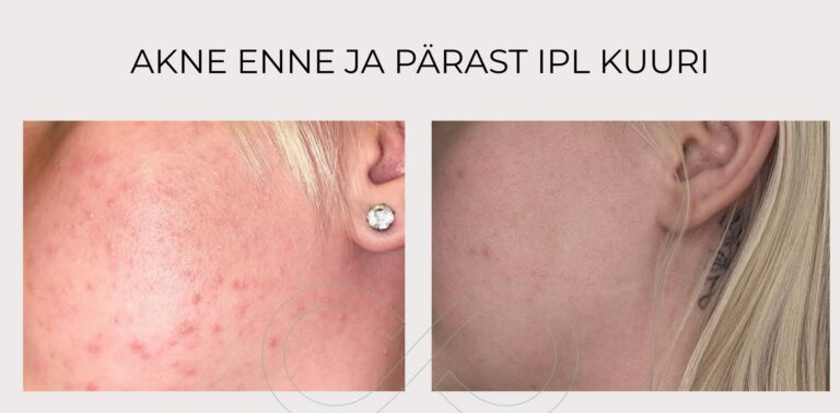 Akne tulemus peale IPL kuuri