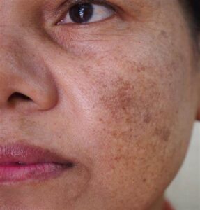 Melasma näide - päikesest tingitud pigmendilaigud